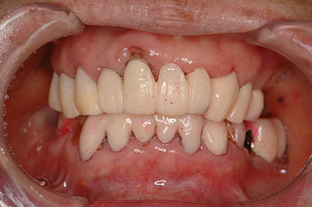歯周病治療のケース