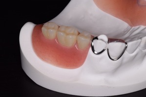 一般的な義歯