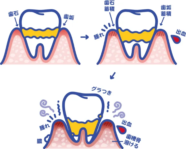 歯のイラスト